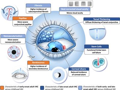 Vernal keratoconjunctivitis in adults: a narrative review of prevalence, pathogenesis, and management